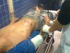 Nam thanh niên bị thanh gỗ đâm xuyên bụng