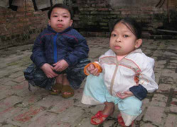 Thương tâm hai anh em mắc bệnh 'người ếch'