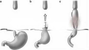 Mổ nội soi teo thực quản lần đầu tiên tại miền Nam