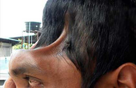 Lạ kỳ người đàn ông sống với nửa hộp sọ