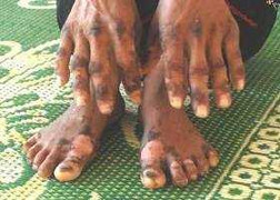 Bộ Y tế quyết tìm nguyên nhân 'bệnh lạ' ở Quảng Ngãi