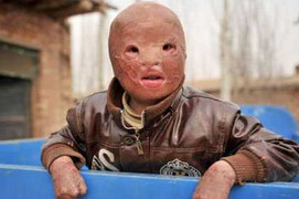 Cậu bé bị thần lửa lấy đi khuôn mặt