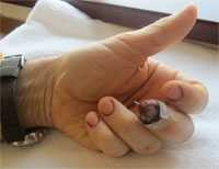 Vi phẫu thành công nối đầu đốt ngón tay bị đứt rời