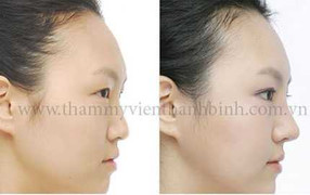 Cận cảnh ca phẫu thuật nâng mũi Hàn Quốc