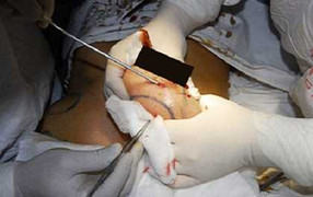 Kiều nữ nhiễm trùng gò bồng đảo vì silicon chợ đen