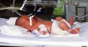 Bú sữa mẹ sớm giúp trẻ sinh non mau thoát khỏi lồng ấp