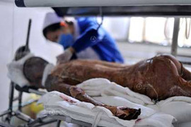 Xót xa cha già xẻ da cứu con gái bỏng 90%