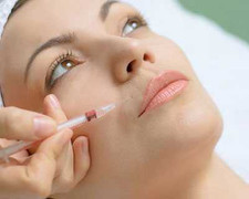 Nếp nhăn xuất hiện do biểu cảm khuôn mặt