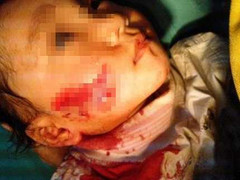 Bị chó cắn, một bé gái tổn thương nặng vùng mặt