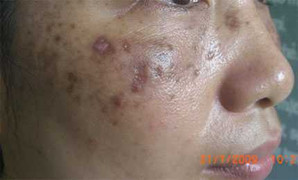 Bị nám da, con trêu mẹ là ngáo ộp