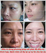 Mụn thịt quanh mắt khiến bạn già trước tuổi