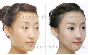Phẫu thuật thẩm mỹ mũi tạo vẻ đẹp tự nhiên