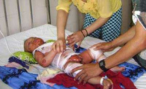 Uống thuốc, bé 9 tháng tuổi nhiễm độc da nghiêm trọng
