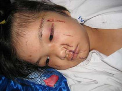 Xử lý cô giáo dùng bật lửa đốt mặt học trò