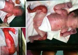 Xót xa bé gái sơ sinh thiếu 40% da