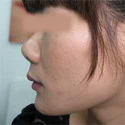 Nâng mũi và những nguy cơ