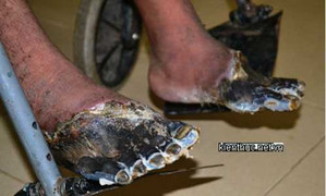 Hai bàn chân người sống bỗng nhiên chết khô