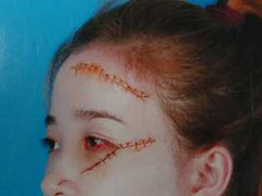 'Trốn' tình trai có vợ, nữ sinh bị rạch mặt