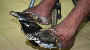 Hút thuốc lá nhiều: Hai bàn chân 'chết' khô