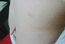 Thương quá bé gái 2 tuổi 'mọc' đuôi dài hơn 2cm