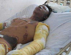 Xe máy bốc cháy, hai nạn nhân bị bỏng nặng