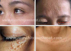 Video: Tư vấn chữa mụn thịt quanh mắt