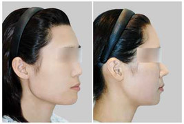 Chất liệu nâng mũi siêu bền mới xuất hiện ở Việt Nam