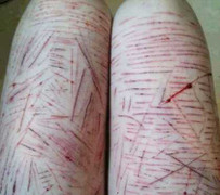 Đau lòng tấm ảnh thiếu nữ trầm cảm tự tay rạch đùi