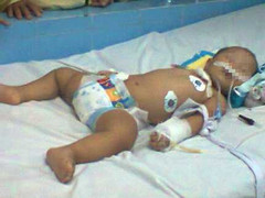 Phẫu thuật mở khí quản bé 14 tháng gắp hạt lạc