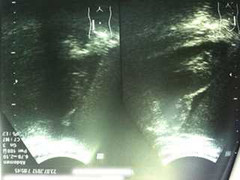 Giá sách đè vỡ gan thiếu nữ giữa đêm khuya