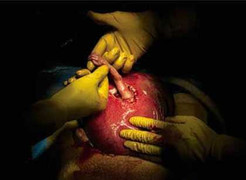 Đang mổ, thai nhi thò tay ra tử cung nắm tay bác sĩ