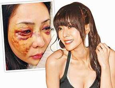 Chân dài bị đại gia đánh đến nhập viện