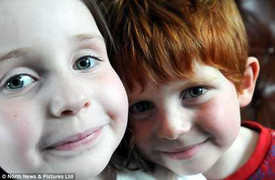 Bệnh lạ: Bỏng da chỉ sau vài giây ra nắng