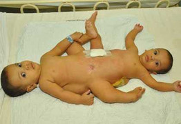 Tách cặp sinh đôi chung cơ quan sinh dục ngoài