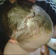 Cắt ghép lại hộp sọ cho bé 3 tuổi