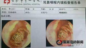 Cận cảnh nhện sống trong tai người
