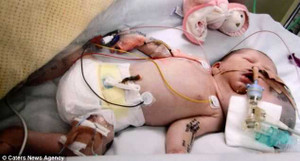 Cô bé mới sinh có khối u to bằng đầu