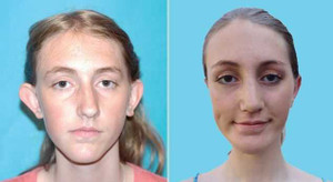 Nữ sinh 'tai voi' phẫu thuật thẩm mỹ để đến trường