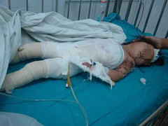 Hất đổ nồi sữa đậu nành đang sôi, hai dì cháu nhập viện