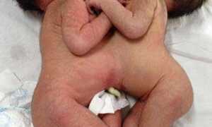 TP.HCM: Hai bé gái song sinh dính liền bụng ngực