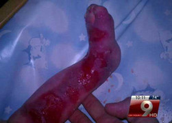 Đau đớn cô bé sinh ra không có da chân