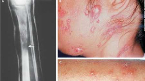 Sở Y tế TP.HCM phủ nhận tin xuất hiện bệnh lạ giống HIV