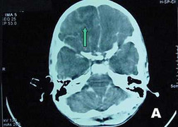 'Amip ăn não người' xuất hiện ở VN khủng khiếp mức nào?