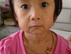 Video: Bé 3 tuổi mặt già như bà lão ở Cà Mau