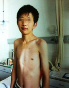 Bệnh nhân bị biến dạng xương ức giống gà