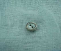 Phát hiện dị vật âm đạo ở trẻ 3 tuổi