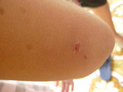 Hà Nội: Bọ xít hút máu người gây sốt cao