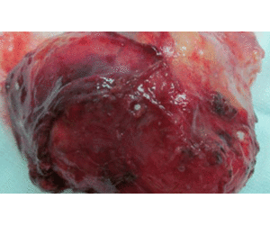 Bóc tách khối u khổng lồ trong lồng ngực thiếu nữ