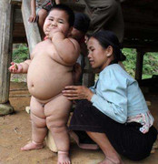 Thử lý giải nguyên nhân béo phì bé trai 2 tuổi khổng lồ