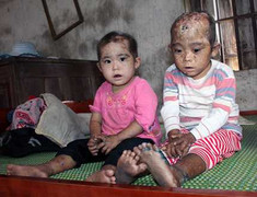 Thảm cảnh hai đứa trẻ lở loét toàn thân, răng đen kịt